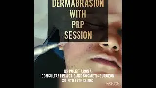 SEVERE ACNE SCARS TREATMENT