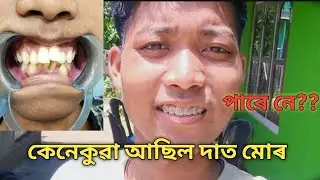 কেনেকুৱা আছিল দাত মোৰ 🥴😵‍💫|Braces Journey