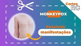 Monkeypox - Quais são as possíveis manifestações?