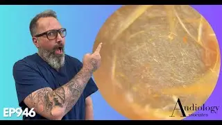 OMG! SUCH A TOUGH EAR WAX REMOVAL! - EP946