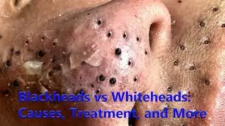 Blackheads vs Whiteheads: Causes, Treatment, and More
