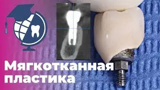 Мягкотканная пластика. Протокол увеличения объема мягких тканей вокруг имплантата.