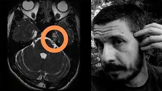Mi experiencia con UN TUMOR en la Cabeza