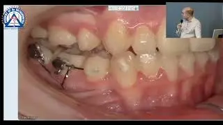 Monday Tip: Uprighting Ectopic Molars