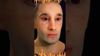 मुँह में छाला￼ कैसे होता हैं ? Mouth ulcer