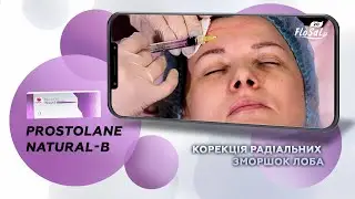 Безпечна корекція радіальних зморшок лоба з ревіталізантом 💉Prostolane Natural-B