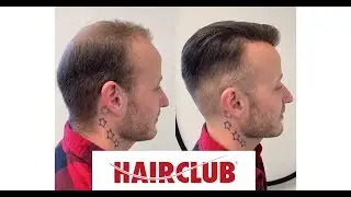 Non surgical hair replacement solution! - Hair Club
