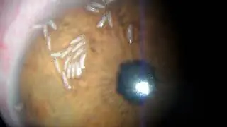 Внимание!!!  Видео не для слабонервных ☝️   Гельминты в глазу