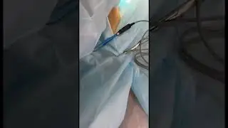 Неврома Мортона ( видео с операции ) #массаж #доктор #massage #юмор #новости #топ #спорт #боль