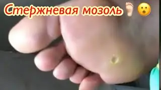 Стержневая мозоль🦶🏻