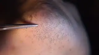 Hair removal asmr pull out with Tweezers  Satisfying pull out beard 12min 202403-3