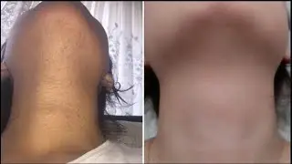 yüz tüylerinden nasıl kurtuldum 2