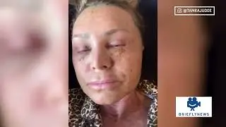 'Real Housewives' Tamra Judge Shows Off Post Surgery Transformation