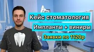 Продвижение стоматологии кейс Яндекс Директ. Как продвигать стоматологию?