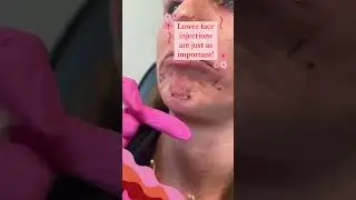 Lower Face Injections are just as Important!