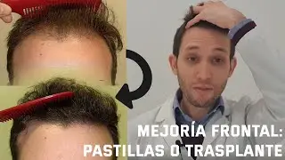 Dermatologist explains how to improve frontal androgenetic alopecia