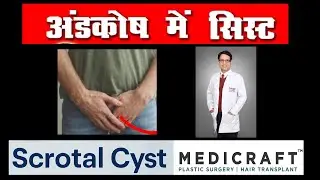 SCROTAL CYST I SCROTAL CYST TREATMENT DEHRADUN I अंडकोष के सिस्ट I CYST REMOVAL SURGERY I