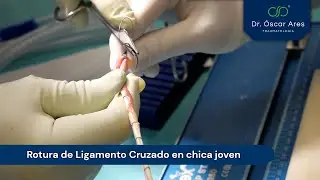 Rotura de Ligamento Cruzado en chica joven - Dr. Oscar Ares