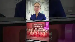 Пластика рецессии десны