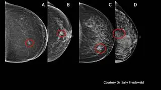 Screening Algorithms in Dense Breasts