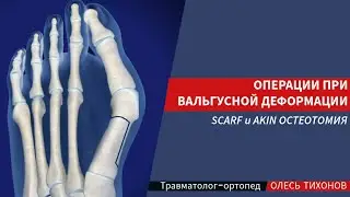 Операции при вальгусной деформации стопы SCARF и AKIN остеотомия 🔪🦶