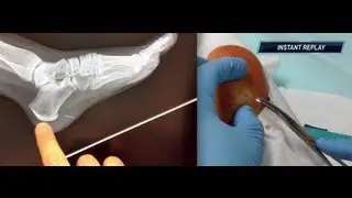 Needle stuck in the heel of my foot!