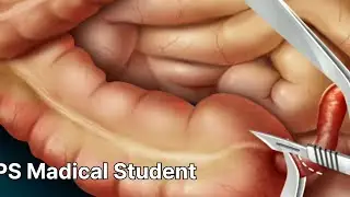 Appendix surgery.. (open technique)