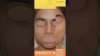 Rhinoplasty Surgery in Delhi | Rhinoplasty Before and After 