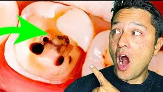 Molar Root Canal - Calcified Canals
