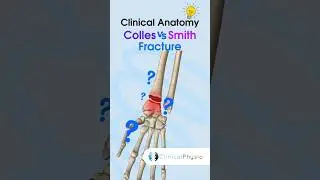 Colles vs. Smith Fracture 