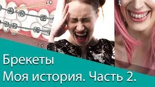 Брекеты. Моя история. Часть 2.| Спустя год | Минивинты |
