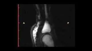Real-Time Visualization of Joint Cavitation