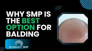 Why SMP is the best option for balding