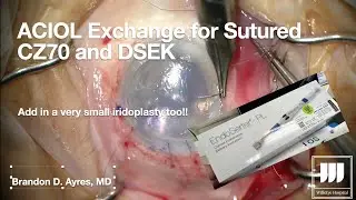 Anterior Chamber IOL Exchange for Sutured CZ70BD with DSEK and Small Iridoplasty (4TP)