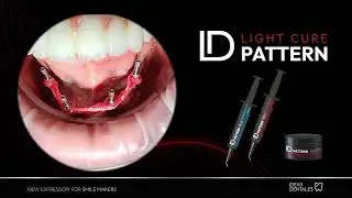 Ferulización de copings de impresión con ID Light Cure Pattern Gel Implant
