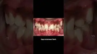 Teeth Problems that cause you to need Braces