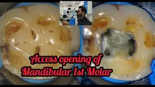 Access opening of Mandibular1st Molar# step by step demonstration# Rct for beginners# dentallectures