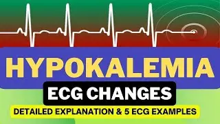 ECG Changes in Hypokalemia | Hypokalemia ECG Changes | Detailed Explanation with Examples