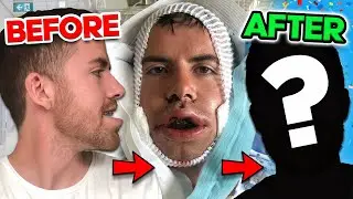 I HAD DOUBLE JAW SURGERY | My experience with an underbite... *Before and After*
