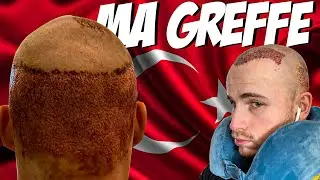 MA GREFFE DE CHEVEUX EN TURQUIE !