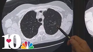UTMC uses Cytalux drug to help remove lung cancer