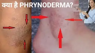 Phrynoderma(toad skin) treatment