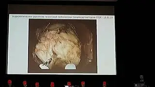 2024 03 28 Первенство01 Соколов СА К чему готовиться при удалении гигантского подслизистого образова