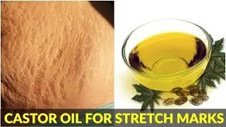Castor Oil for Stretch Marks  Stretch Mark Removal