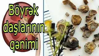 BÖYRƏK DAŞINI NECƏ SALMAQ OLAR - Böyrəkdəki urat daşlarını parçalayan -  Möcüzəvi bitki