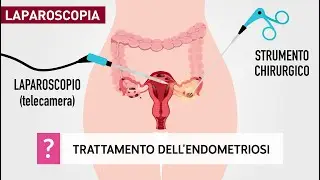 Trattamento dell’endometriosi e laparoscopia