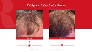 Jeunesse RVL Scalp Infusion