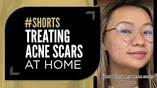 The Most Effective Treatment for Treating Acne Scars At Home 