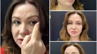 СМАС лица и шеи