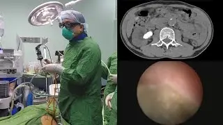 Mini PCNL trainig video